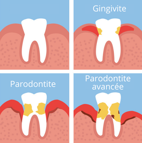 Gingivites et parodontites