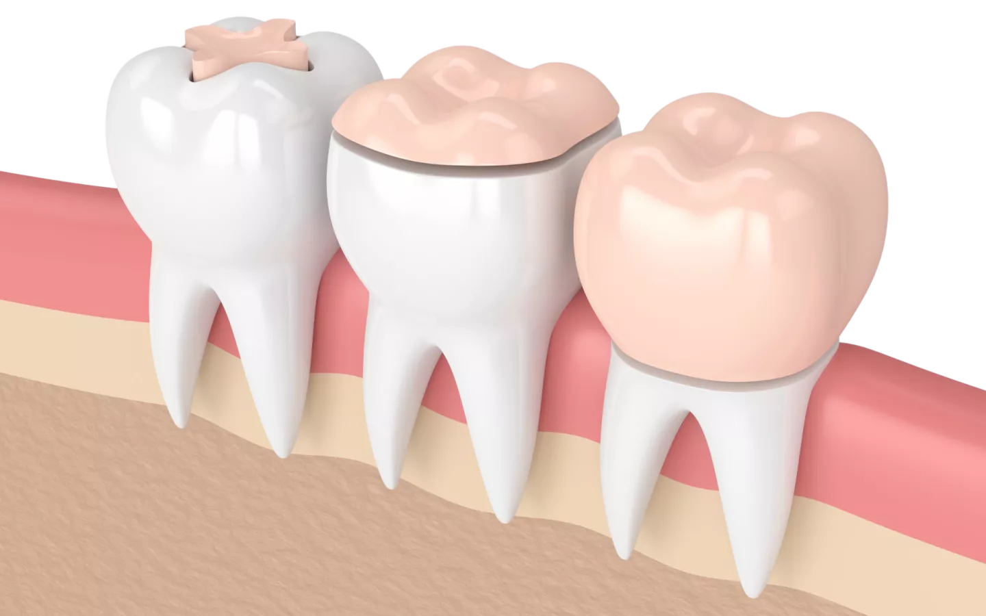 Couronne dentaire: une prothèse qui remplace la partie visible de la dent