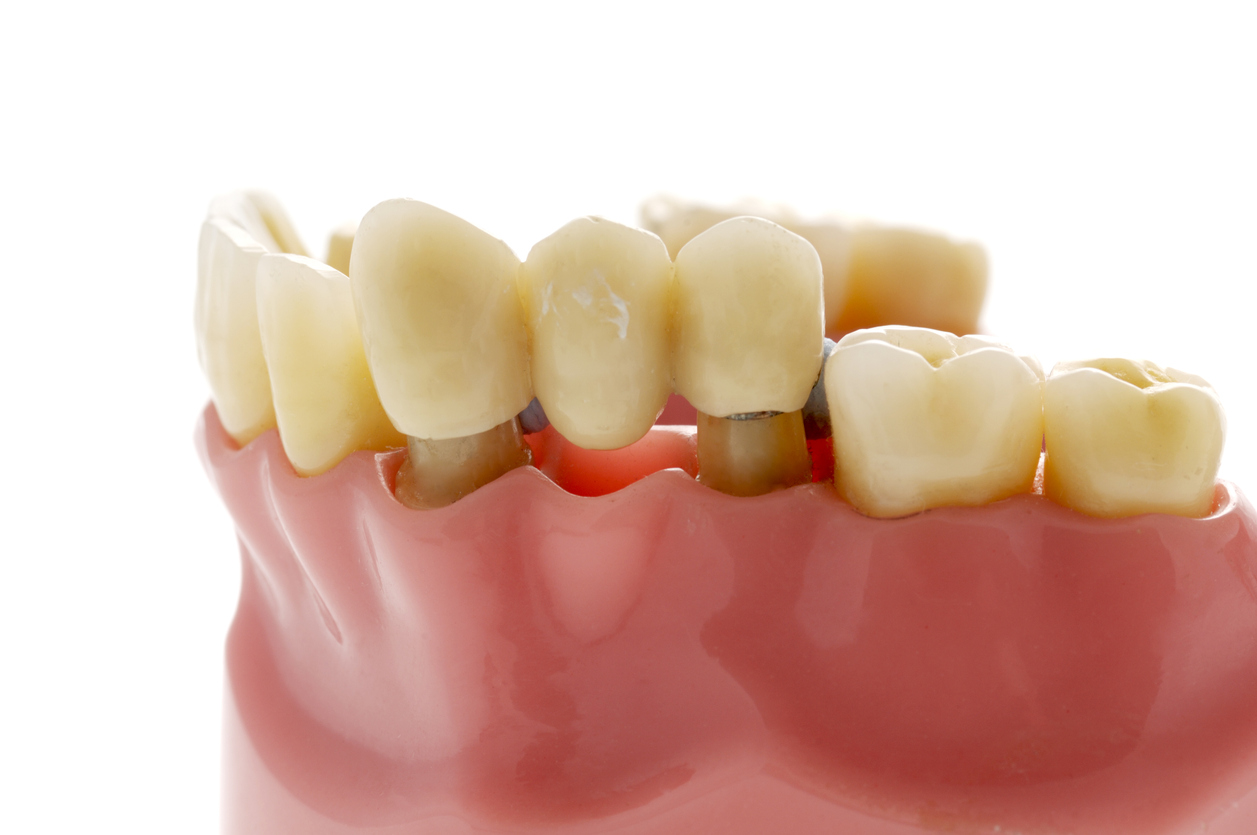 Bridge dentaire : quel prix et quel remboursement ?
