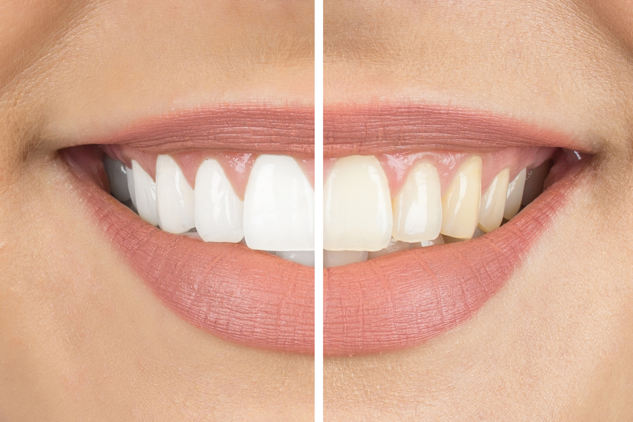 Blanchiment des dents : traitements et prise en charge
