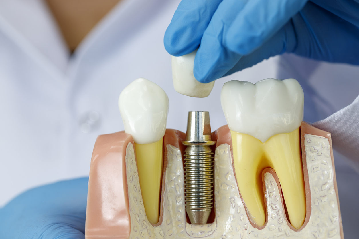Quel prix pour les implants dentaires ?