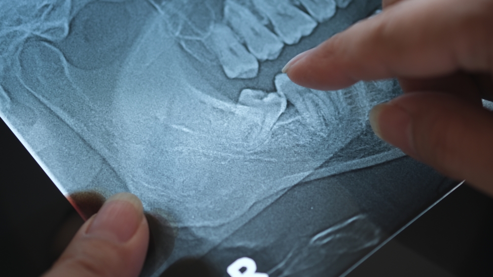 Prix de l'extraction des dents de sagesse : tarif et remboursement