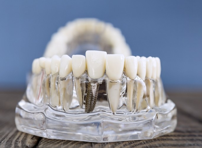 Quelle est la mutuelle qui rembourse le mieux les implants dentaires ?
